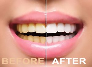 Teeth Whitening Smile before and after