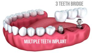 Multi Teeth Dental Implant