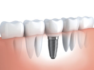 Single Front Dental Implant