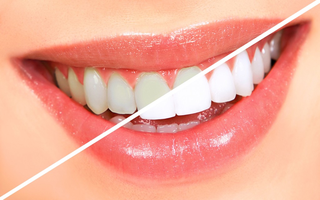 Dental Bleaching