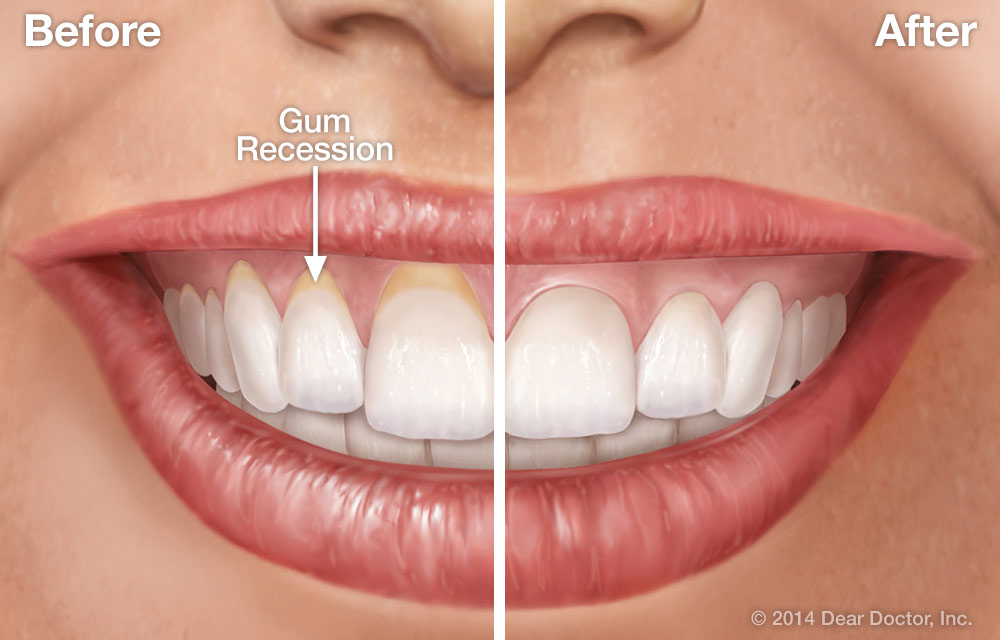 Gum Contouring in Arlington VA Before & After