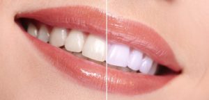 Glo Teeth Whitening