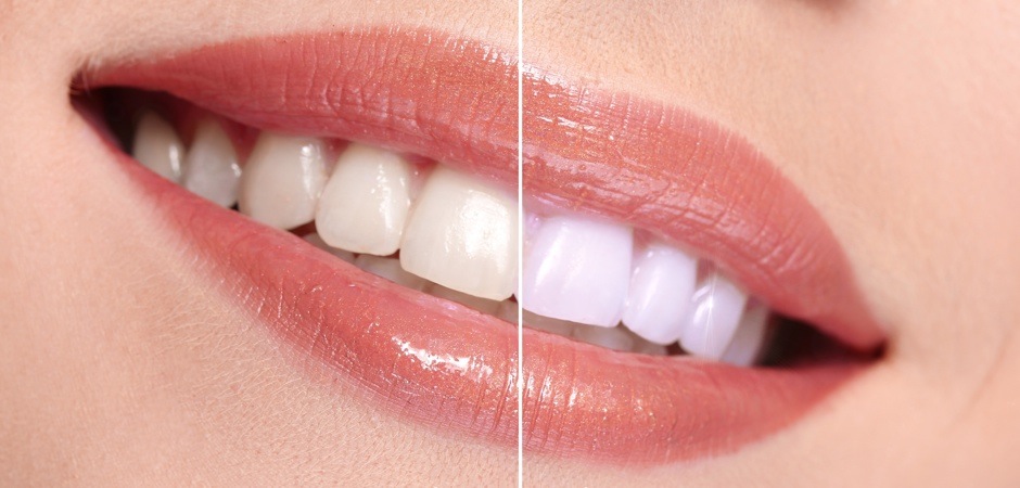 Glo Teeth Whitening